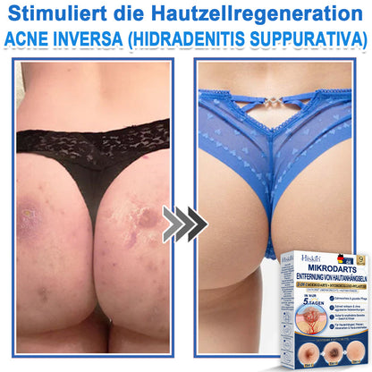 HISKIN® 2-in-1 Mikronadel- & Hydrokolloid-Pflaster | Entferner für erhabene Muttermale, Akne, flache Warzen & Hautanhängsel | Verbessert Falten, Narben & Hautunreinheiten | Unsichtbare Stern-Pickelpflaster für Gesicht & Körper