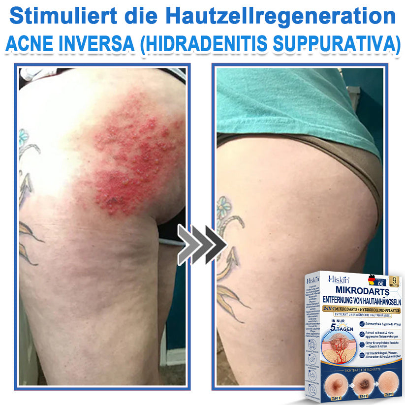 HISKIN® 2-in-1 Mikronadel- & Hydrokolloid-Pflaster | Entferner für erhabene Muttermale, Akne, flache Warzen & Hautanhängsel | Verbessert Falten, Narben & Hautunreinheiten | Unsichtbare Stern-Pickelpflaster für Gesicht & Körper