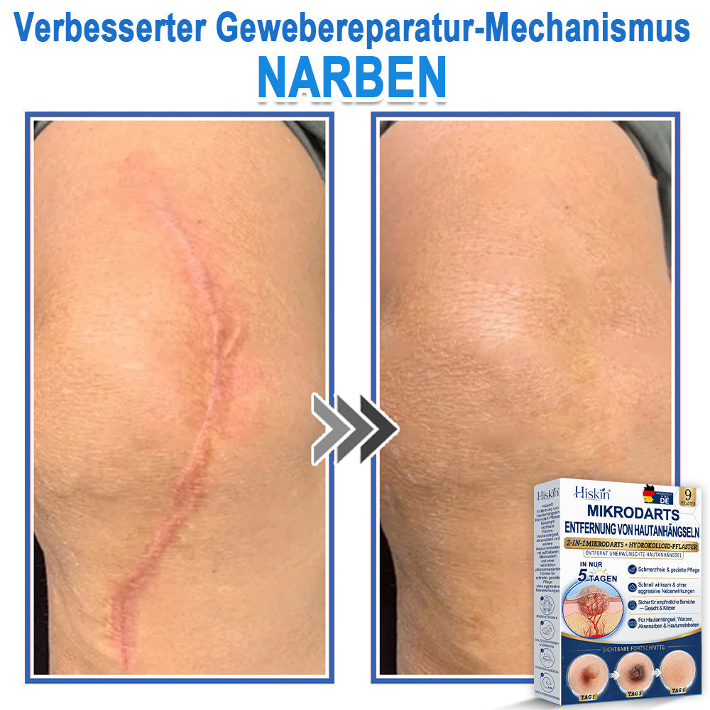 HISKIN® 2-in-1 Mikronadel- & Hydrokolloid-Pflaster | Entferner für erhabene Muttermale, Akne, flache Warzen & Hautanhängsel | Verbessert Falten, Narben & Hautunreinheiten | Unsichtbare Stern-Pickelpflaster für Gesicht & Körper