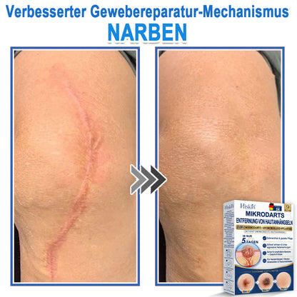 HISKIN® 2-in-1 Mikronadel- & Hydrokolloid-Pflaster | Entferner für erhabene Muttermale, Akne, flache Warzen & Hautanhängsel | Verbessert Falten, Narben & Hautunreinheiten | Unsichtbare Stern-Pickelpflaster für Gesicht & Körper