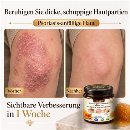 Letzte Chance! Sichern Sie sich diesen Glücksfund mit 90 % Rabatt, um Warzen dauerhaft zu entfernen! 🔥 180-Tage-Geld-zurück-Garantie! Handeln Sie schnell! HISKIN®