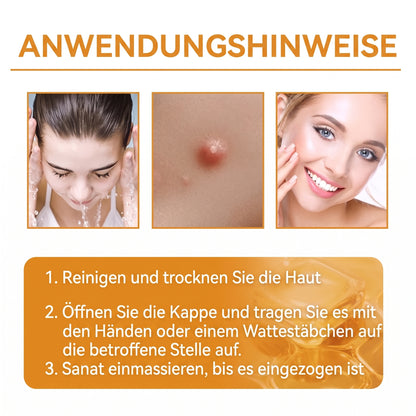 Letzte Chance! Sichern Sie sich diesen Glücksfund mit 90 % Rabatt, um Warzen dauerhaft zu entfernen! 🔥 180-Tage-Geld-zurück-Garantie! Handeln Sie schnell! HISKIN®