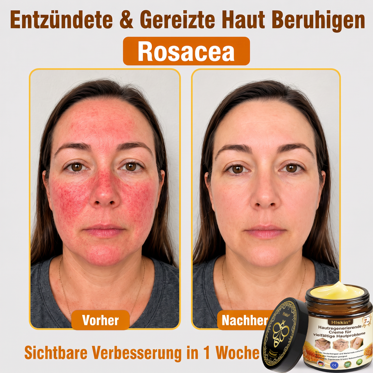 Letzte Chance! Sichern Sie sich diesen Glücksfund mit 90 % Rabatt, um Warzen dauerhaft zu entfernen! 🔥 180-Tage-Geld-zurück-Garantie! Handeln Sie schnell! HISKIN®