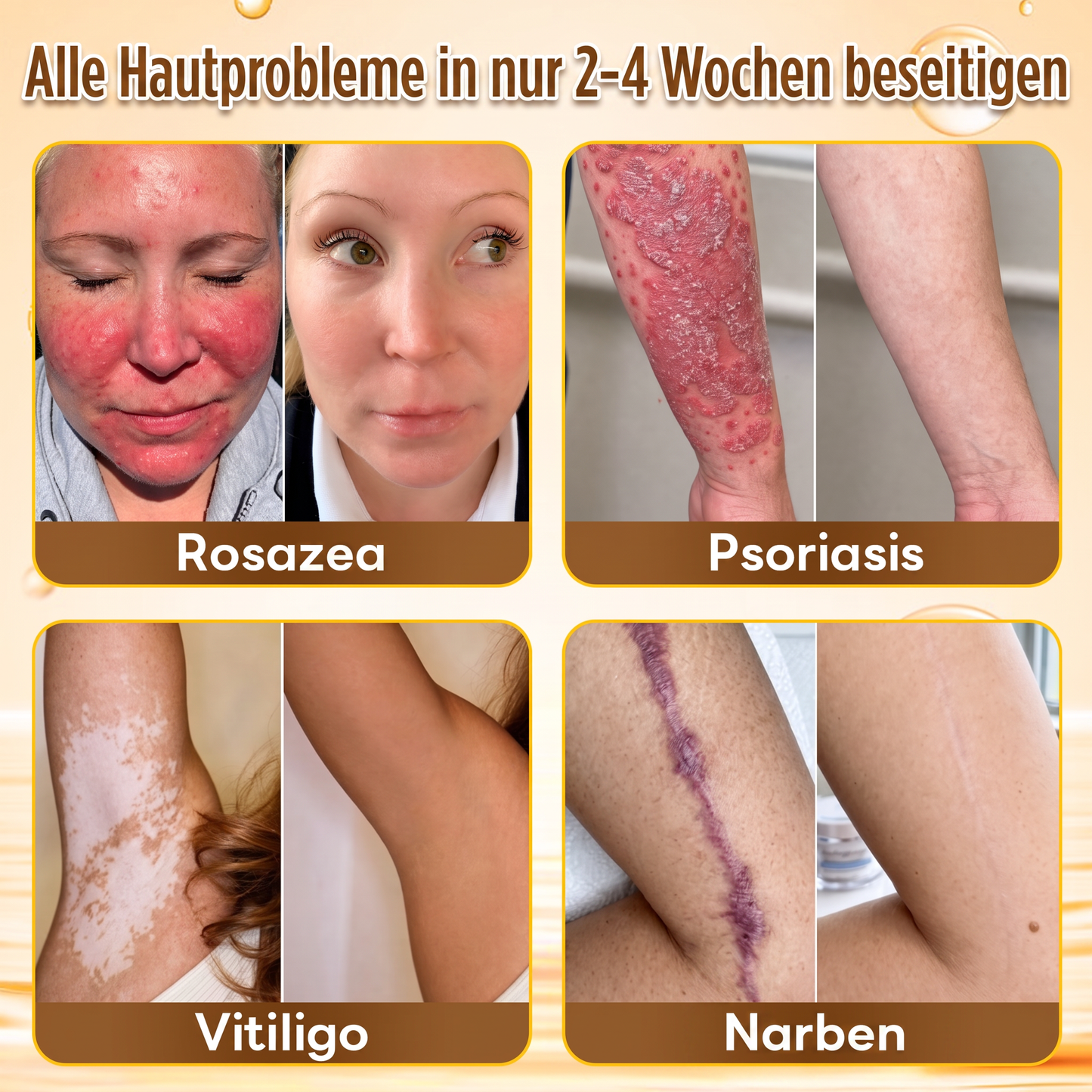 Letzte Chance! Sichern Sie sich diesen Glücksfund mit 90 % Rabatt, um Warzen dauerhaft zu entfernen! 🔥 180-Tage-Geld-zurück-Garantie! Handeln Sie schnell! HISKIN®