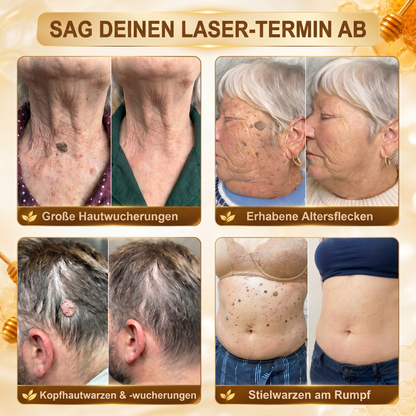 Letzte Chance! Sichern Sie sich diesen Glücksfund mit 90 % Rabatt, um Warzen dauerhaft zu entfernen! 🔥 180-Tage-Geld-zurück-Garantie! Handeln Sie schnell! HISKIN®