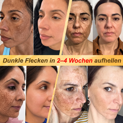 Letzte Chance! Sichern Sie sich diesen Glücksfund mit 90 % Rabatt, um Warzen dauerhaft zu entfernen! 🔥 180-Tage-Geld-zurück-Garantie! Handeln Sie schnell! HISKIN®