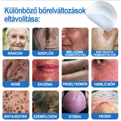 HISKIN® 2-in-1 Mikronadel- & Hydrokolloid-Pflaster | Entferner für erhabene Muttermale, Akne, flache Warzen & Hautanhängsel | Verbessert Falten, Narben & Hautunreinheiten | Unsichtbare Stern-Pickelpflaster für Gesicht & Körper