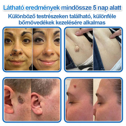 HISKIN® 2-in-1 Mikronadel- & Hydrokolloid-Pflaster | Entferner für erhabene Muttermale, Akne, flache Warzen & Hautanhängsel | Verbessert Falten, Narben & Hautunreinheiten | Unsichtbare Stern-Pickelpflaster für Gesicht & Körper