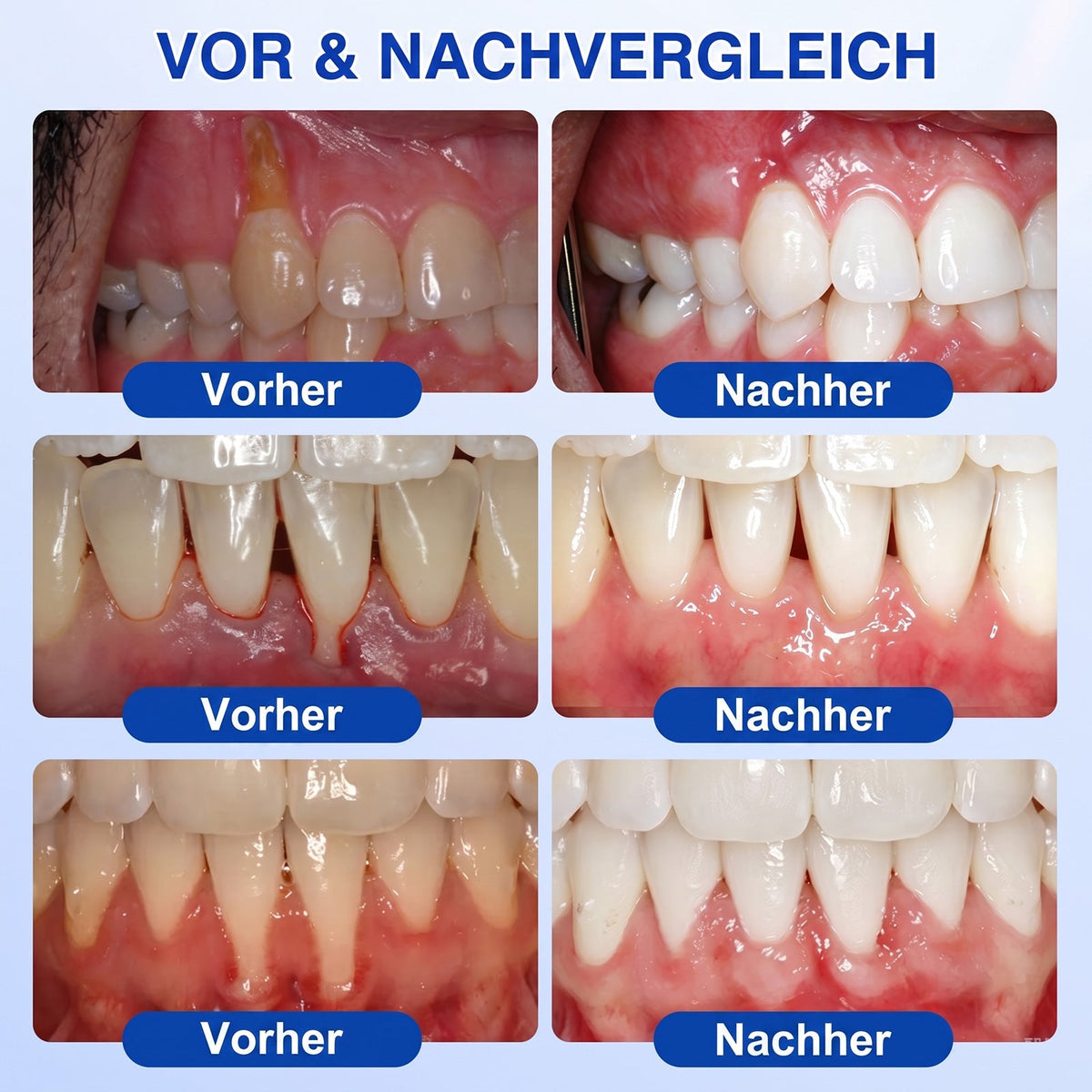 🇩🇪🏆🦷🛡️ Dr. Era® GumRevive — Klinisches Gel: Stoppt Zahnfleischbluten, regeniert Zahnfleisch & festigt Zähne