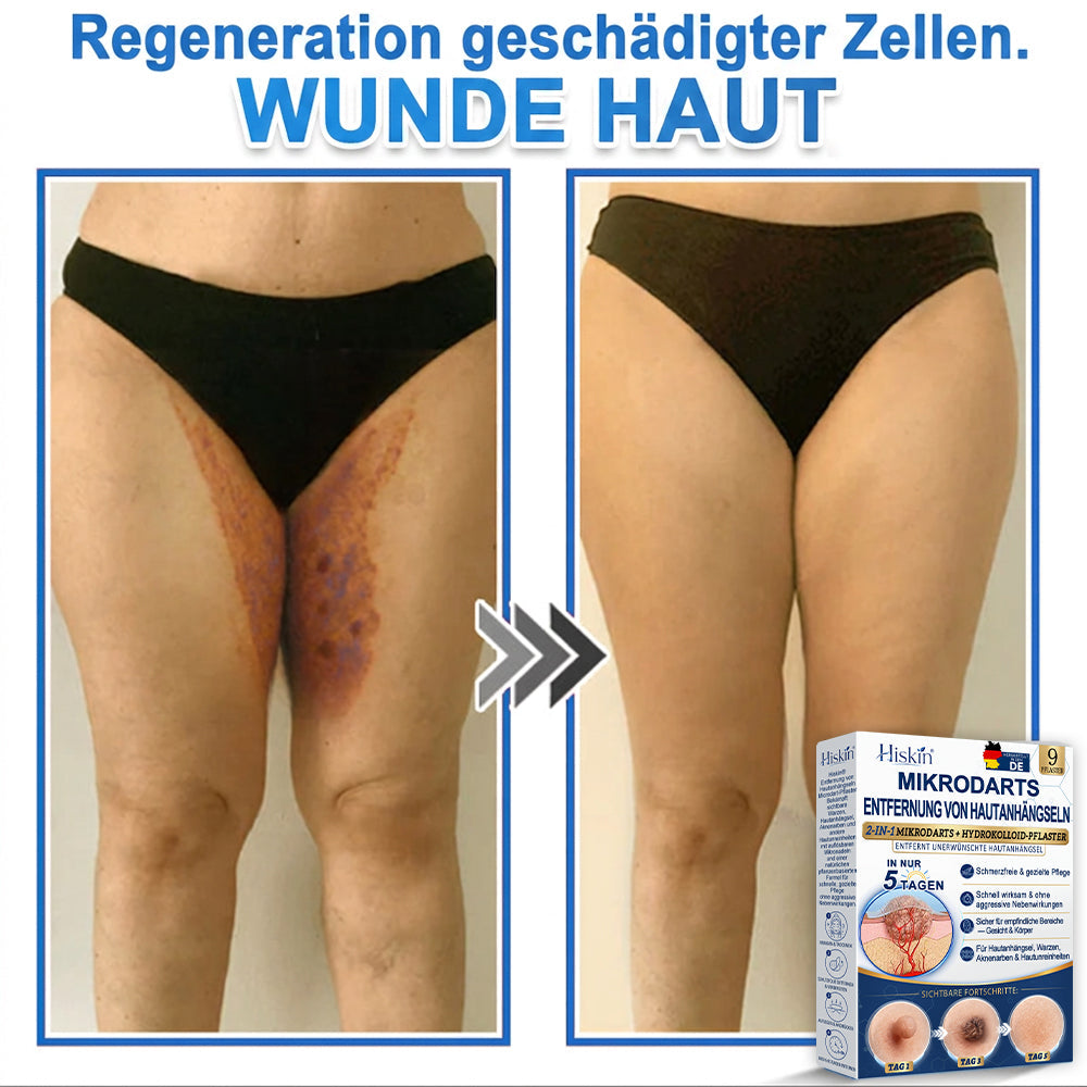 HISKIN® 2-in-1 Mikronadel- & Hydrokolloid-Pflaster | Entferner für erhabene Muttermale, Akne, flache Warzen & Hautanhängsel | Verbessert Falten, Narben & Hautunreinheiten | Unsichtbare Stern-Pickelpflaster für Gesicht & Körper