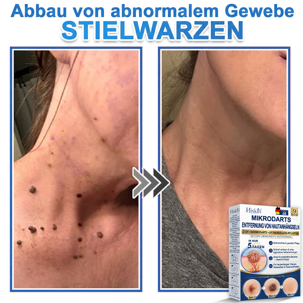 HISKIN® 2-in-1 Mikronadel- & Hydrokolloid-Pflaster | Entferner für erhabene Muttermale, Akne, flache Warzen & Hautanhängsel | Verbessert Falten, Narben & Hautunreinheiten | Unsichtbare Stern-Pickelpflaster für Gesicht & Körper