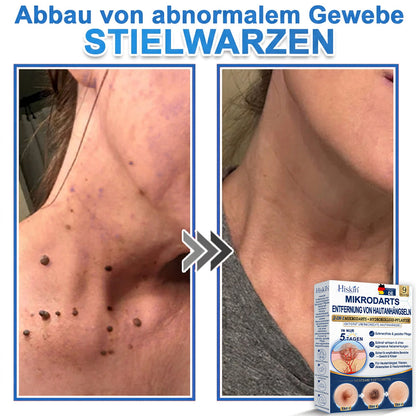 HISKIN® 2-in-1 Mikronadel- & Hydrokolloid-Pflaster | Entferner für erhabene Muttermale, Akne, flache Warzen & Hautanhängsel | Verbessert Falten, Narben & Hautunreinheiten | Unsichtbare Stern-Pickelpflaster für Gesicht & Körper