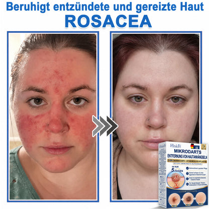 HISKIN® 2-in-1 Mikronadel- & Hydrokolloid-Pflaster | Entferner für erhabene Muttermale, Akne, flache Warzen & Hautanhängsel | Verbessert Falten, Narben & Hautunreinheiten | Unsichtbare Stern-Pickelpflaster für Gesicht & Körper