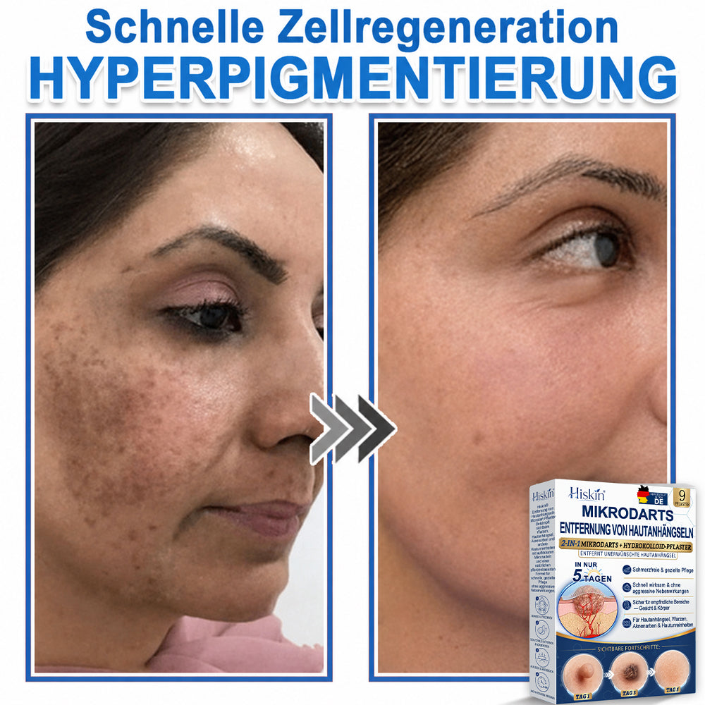 HISKIN® 2-in-1 Mikronadel- & Hydrokolloid-Pflaster | Entferner für erhabene Muttermale, Akne, flache Warzen & Hautanhängsel | Verbessert Falten, Narben & Hautunreinheiten | Unsichtbare Stern-Pickelpflaster für Gesicht & Körper