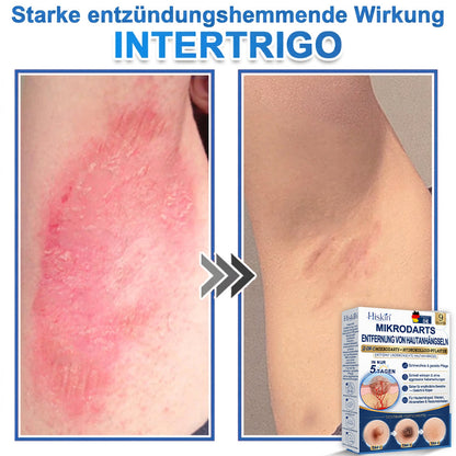 HISKIN® 2-in-1 Mikronadel- & Hydrokolloid-Pflaster | Entferner für erhabene Muttermale, Akne, flache Warzen & Hautanhängsel | Verbessert Falten, Narben & Hautunreinheiten | Unsichtbare Stern-Pickelpflaster für Gesicht & Körper